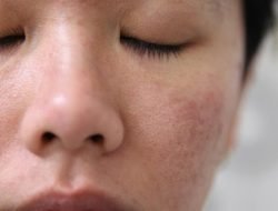 6 Tips Memperbaiki Lapisan Barrier (Pelindung) Pada Kulit