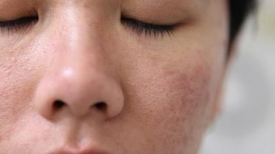 6 Tips Memperbaiki Lapisan Barrier (Pelindung) Pada Kulit