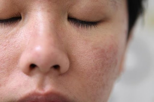 6 Tips Memperbaiki Lapisan Barrier (Pelindung) Pada Kulit